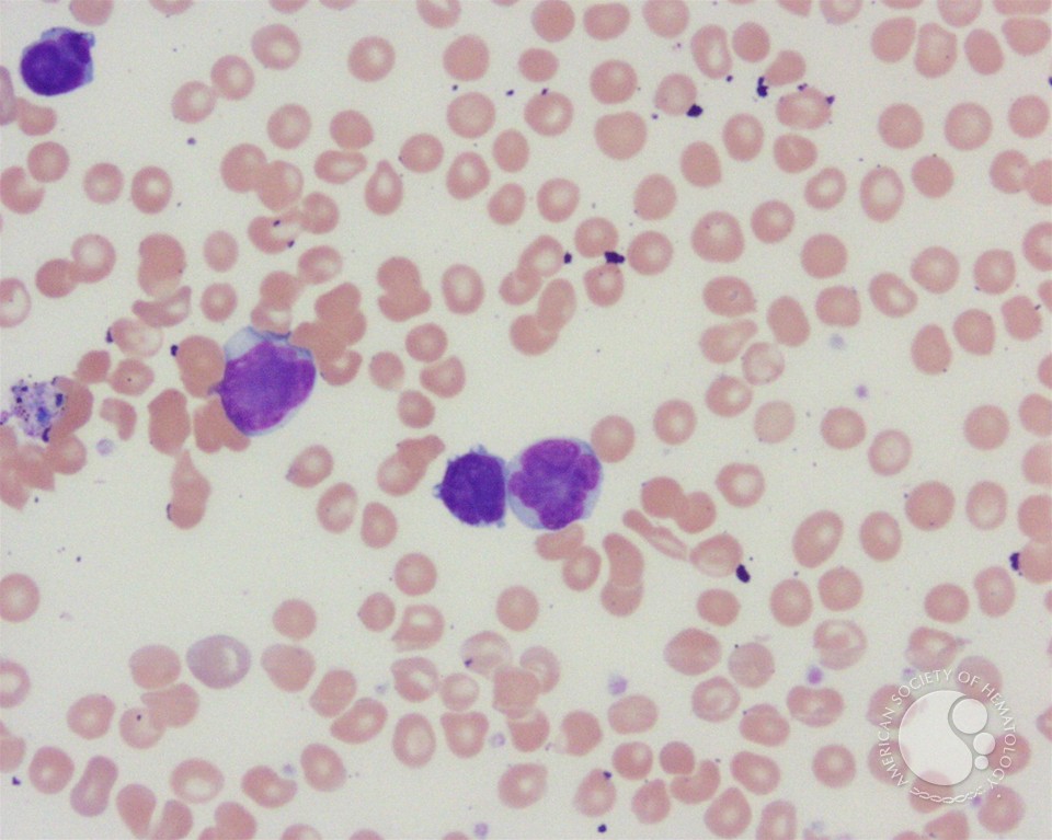 Adult T-cell leukemia/lymphoma peripheral smear - 2.