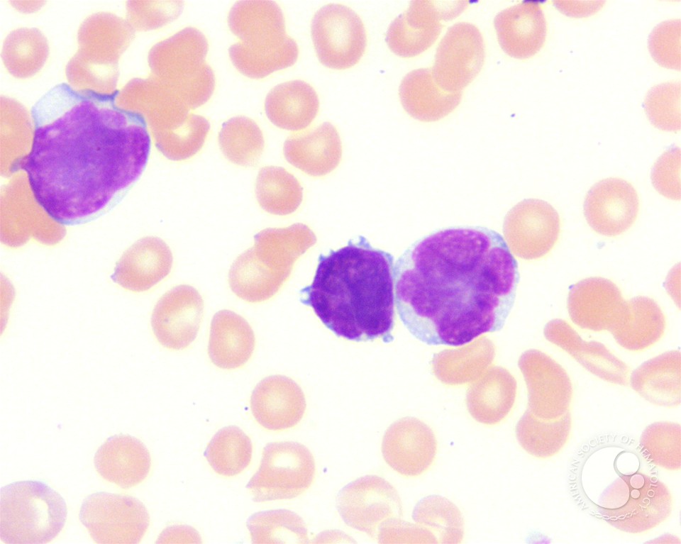 Adult T-cell leukemia/lymphoma peripheral smear - 3.