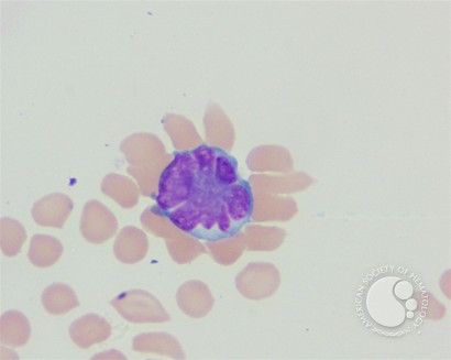 Adult T-cell leukemia/lymphoma peripheral smear - 4.