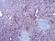 Ruptured spleen due to infectious mononucleosis - 8.