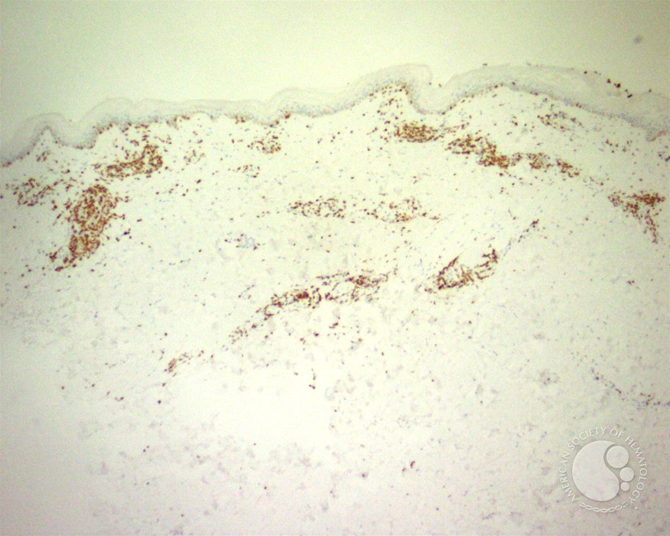 Adult T-cell leukemia/lymphoma involving the skin - 3.