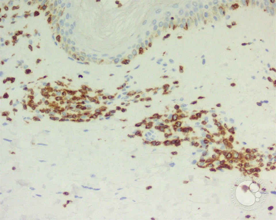 Adult T-cell leukemia/lymphoma involving the skin - 4.