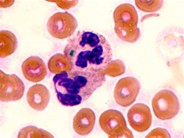 Green Neutrophil Inclusions in a Patient with Liver Disease