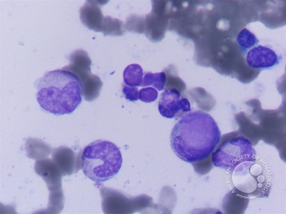 LE cells in BMA