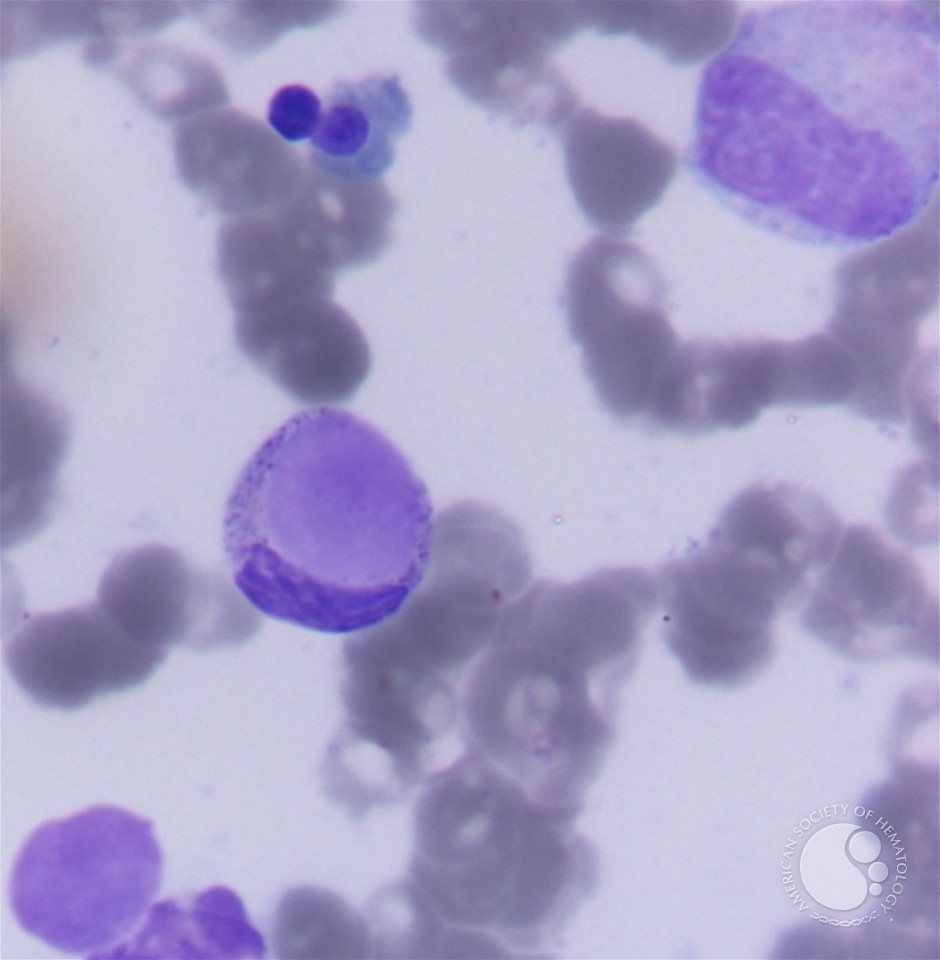 LE cells in BMA, another image