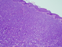 Myeloid sarcoma