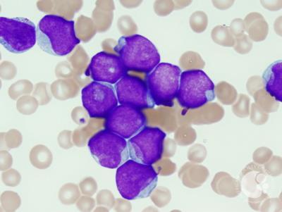 Acute myeloid leukemia with mutated NPM1