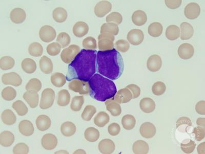Acute myeloid leukemia with mutated NPM1