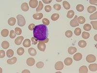 acute-myeloid-leukemia-with-myelodysplasia-related-changes-pb