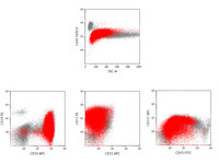 Acute myeloid leukemia with the t(8;21)(q22;22) Flow cytometry