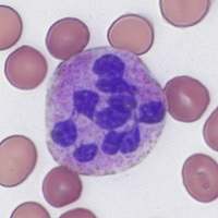 Hypersegmented neutrophil