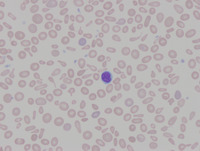 Congenital sideroblastic anemia peripheral blood