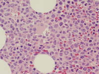 Therapy-related myeloid neoplasm (Acute myeloid leukemia)