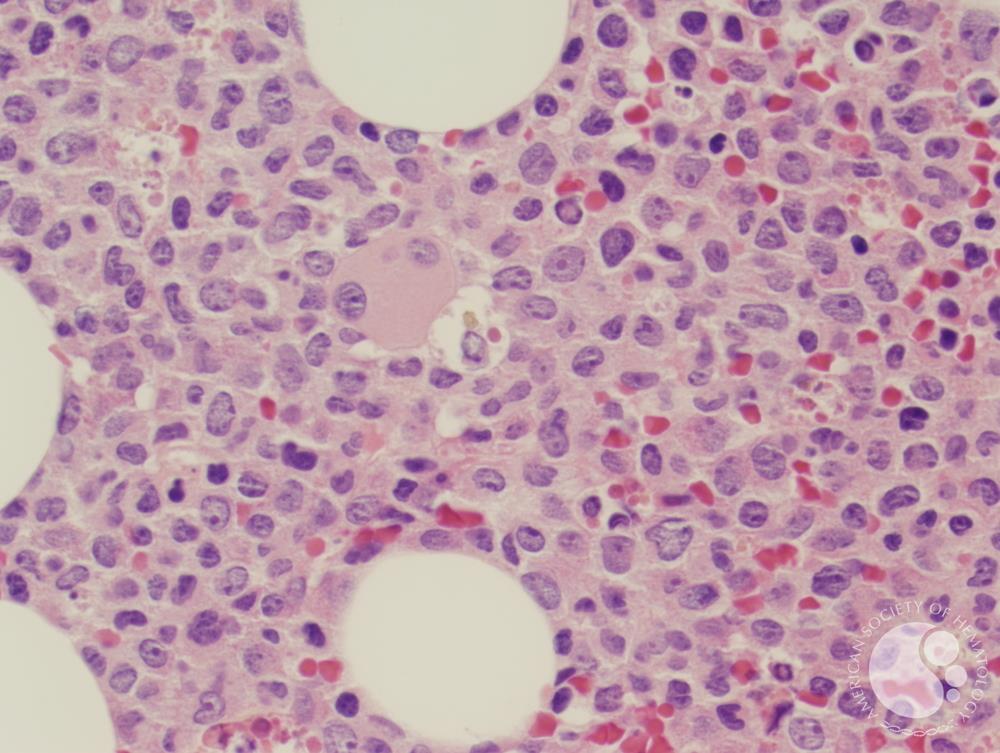 Therapy-related myeloid neoplasm (Acute myeloid leukemia)
