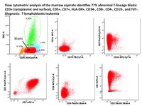 T cell ALL Flow Cytometry