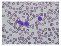 T cell ALL peripheral blood