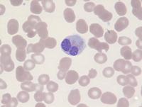 Hematolymphoid neoplasm with PDGFRA rearrangement 10