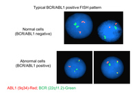 BCR-ABL FISH