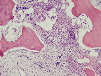 Post-polycythemic myelofibrosis, bone marrow core 1