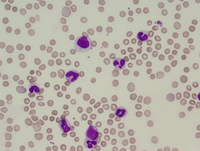 Atypical chronic myeloid leukemia, BCR-ABL1 negative 1