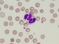 Atypical chronic myeloid leukemia, BCR-ABL1 negative 2