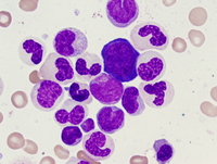 Atypical chronic myeloid leukemia, BCR-ABL1 negative 3