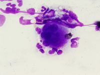 Atypical chronic myeloid leukemia, BCR-ABL1 negative 4