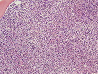 Atypical chronic myeloid leukemia, BCR-ABL1 negative 5