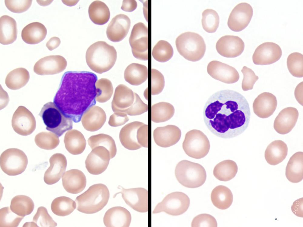 Refractory anemia with excess blasts -1 (RAEB-1) 1