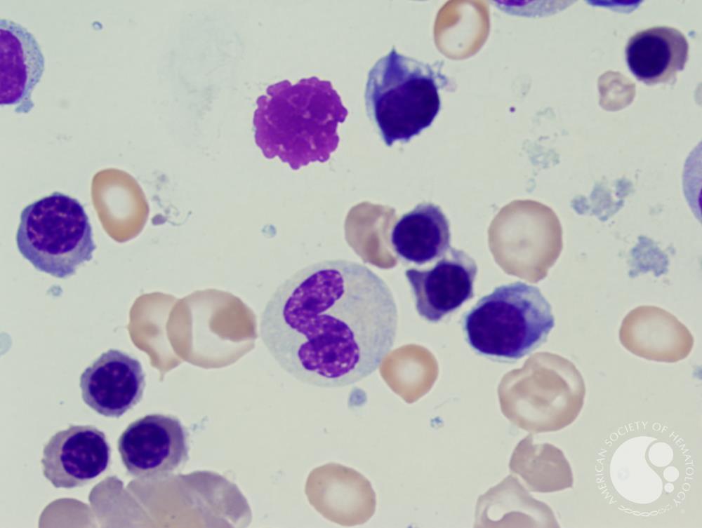 Refractory anemia with excess blasts -1 (RAEB-1) 2