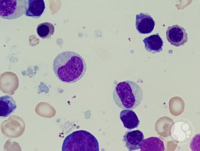 Refractory anemia with excess blasts -1 (RAEB-1) 3