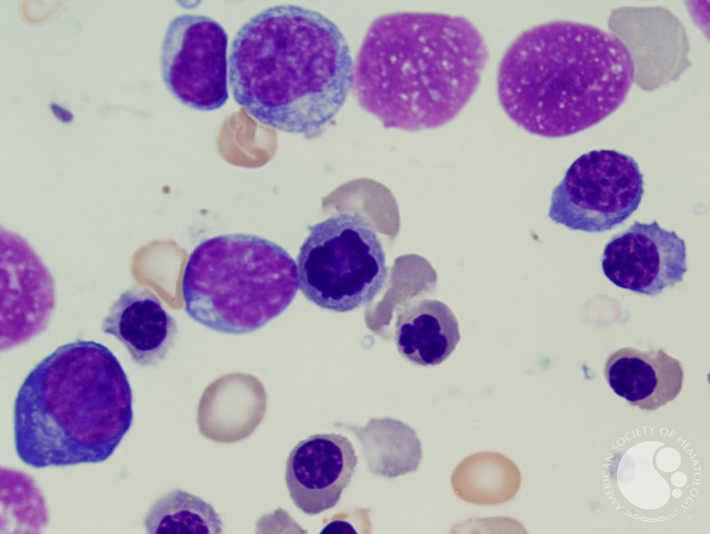 Refractory anemia with excess blasts -1 (RAEB-1) 4