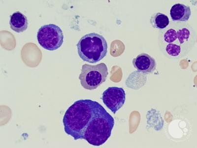 Refractory anemia with excess blasts -1 (RAEB-1) 5