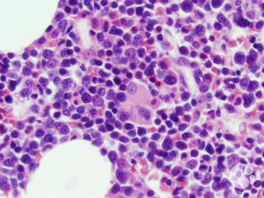 Refractory anemia with excess blasts -1 (RAEB-1) 7