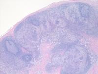 Reactive nodal sinus histiocytosis