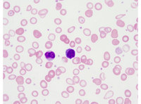 Microcytosis with lymphocyte for comparison