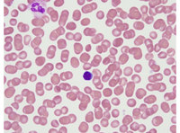 Normocytic rbcs with lymphocyte for comparison
