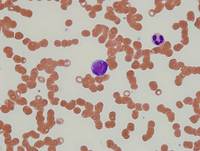 Peripheral blood- Blastic plasmacytoid dendritic cell neoplasm