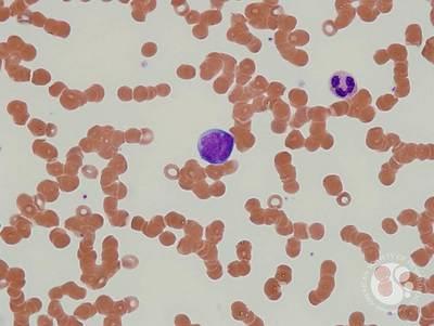 Peripheral blood- Blastic plasmacytoid dendritic cell neoplasm