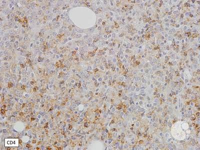 Immunostains - Blastic plasmacytoid dendritic cell neoplasm 1