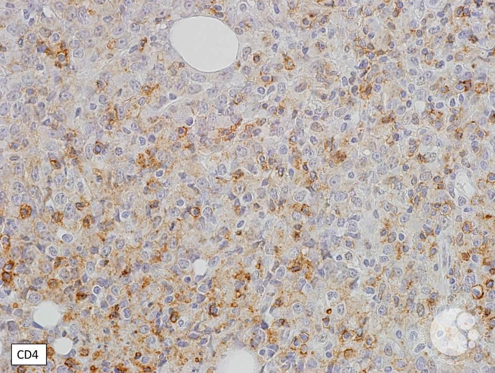 Immunostains - Blastic plasmacytoid dendritic cell neoplasm 1