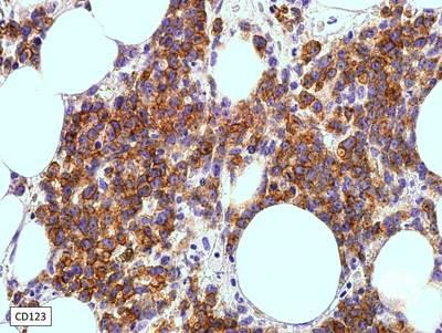 Immunostains - Blastic plasmacytoid dendritic cell neoplasm 3