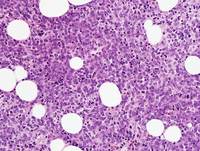 Core biopsy - Blastic plasmacytoid dendritic cell neoplasm 1
