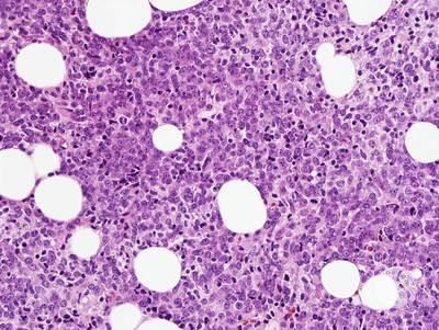 Core biopsy - Blastic plasmacytoid dendritic cell neoplasm 1