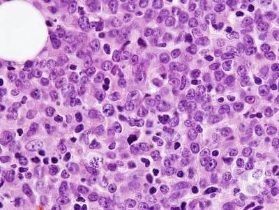 Core biopsy - Blastic plasmacytoid dendritic cell neoplasm 2