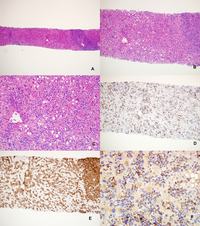 Hepatosplenic T cell lymphoma