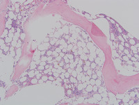 Refractory cytopenia of childhood, GATA2 deficiency related