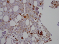 Refractory cytopenia of childhood, GATA2 deficiency related Factor VIIIvw immunohistochemistry stain