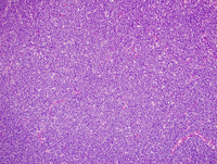 Mantle cell lymphoma 2