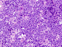 Diffuse large Bcell lymphoma, Leg type 1